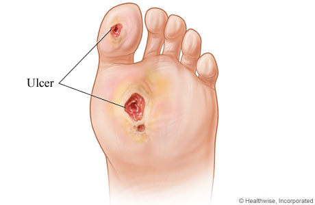 Foot Ulcer Illustration - Heathwise, INC.