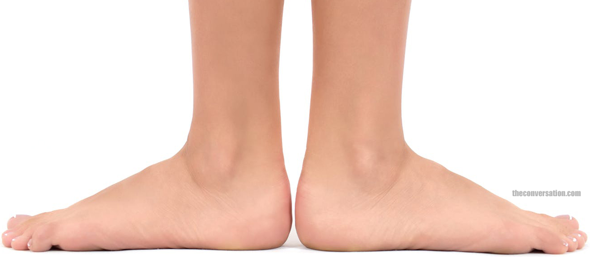 Pediatric - Flexible Flatfoot, Foot & Ankle