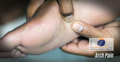 Understanding Bunions: Causes, Treatment, and Prevention