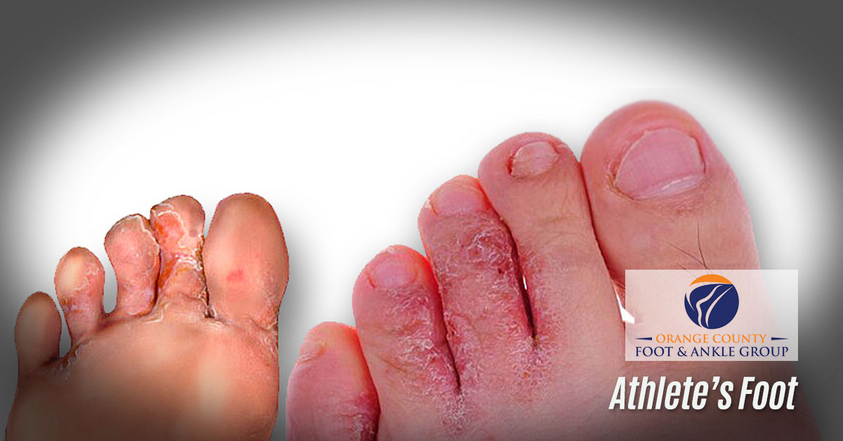 Athletes Foot