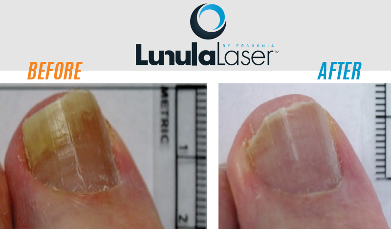 Laser device applied