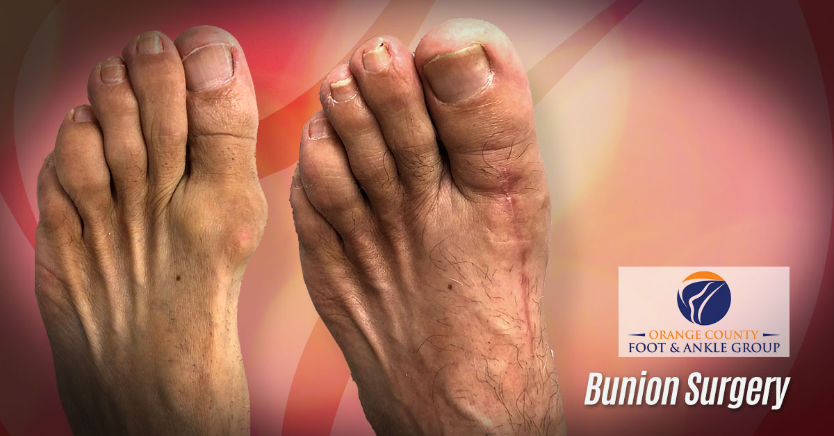 Bunions (Hallux Abducto Valgus)