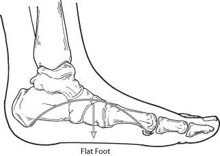 Flat Foot
