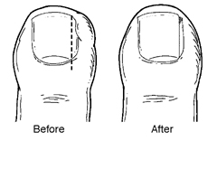 Ingrown toenail symptoms