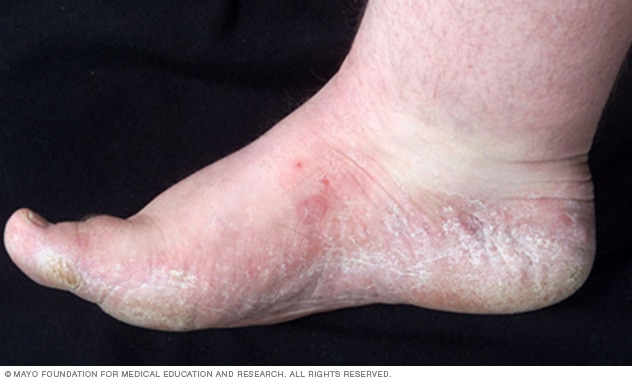 Examining Foot For Fungal Infection