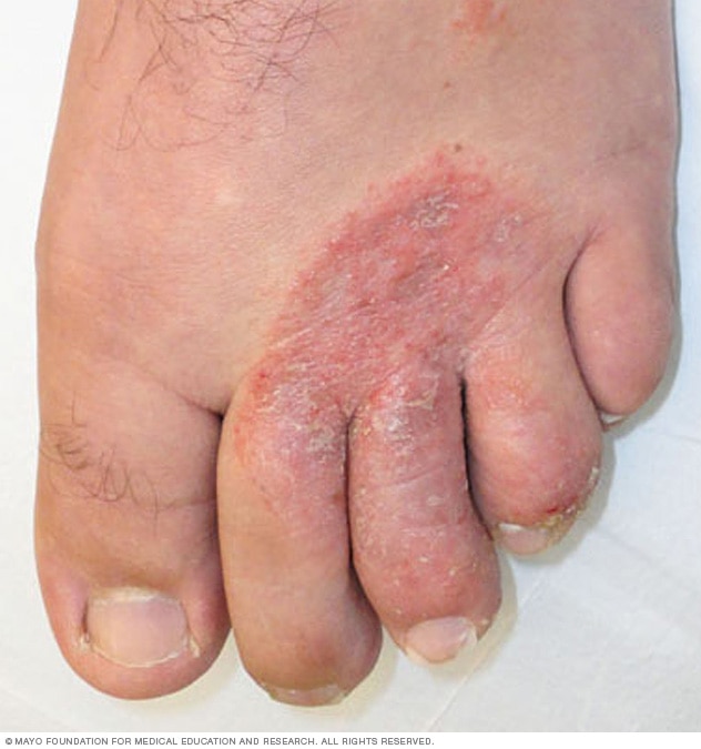 Podiatrist Treating Athlete's Foot
