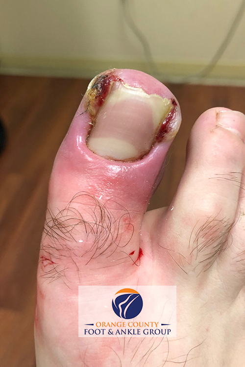 Graphic Ingrown Toenail