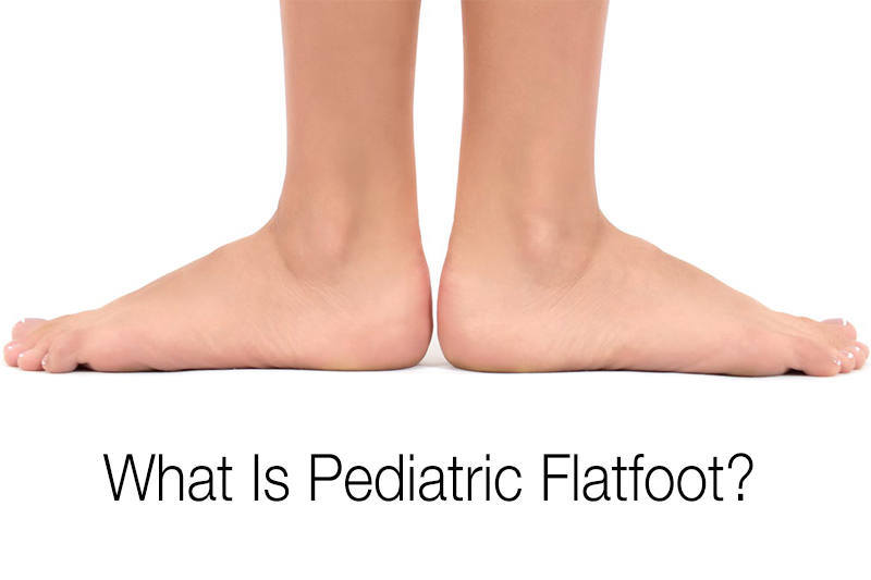 Pediatric Flatfoot