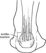 Achilles Tendon