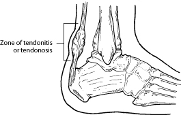 Achilles Tendonitis