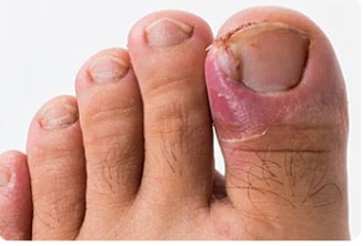 Ingrown Toenails