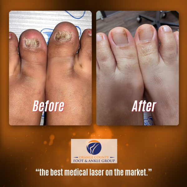 Toenail Fungus Example 2