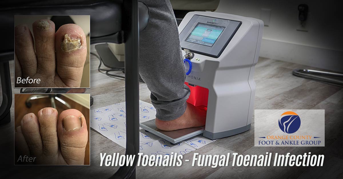 Fungal Toenails - Orange County Foot & Ankle Group