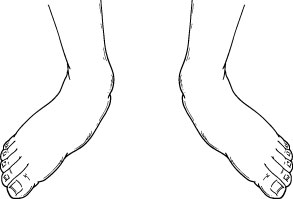  Pediatric Flatfoot_3b - OCfeet.com