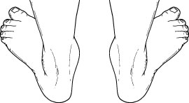  Pediatric Flatfoot_2 - OCfeet.com